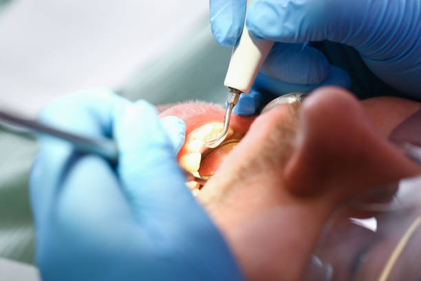 Best Emergency Tooth Extraction in Blue Ridge, GA