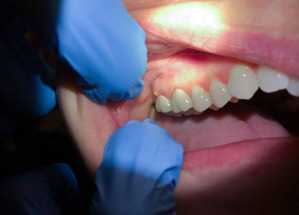 Best Emergency Dental Care for Broken or Chipped Teeth in Blue Ridge, GA